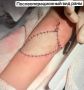 Хирурги в Ижевске прооперировали подростка с огромной родинкой